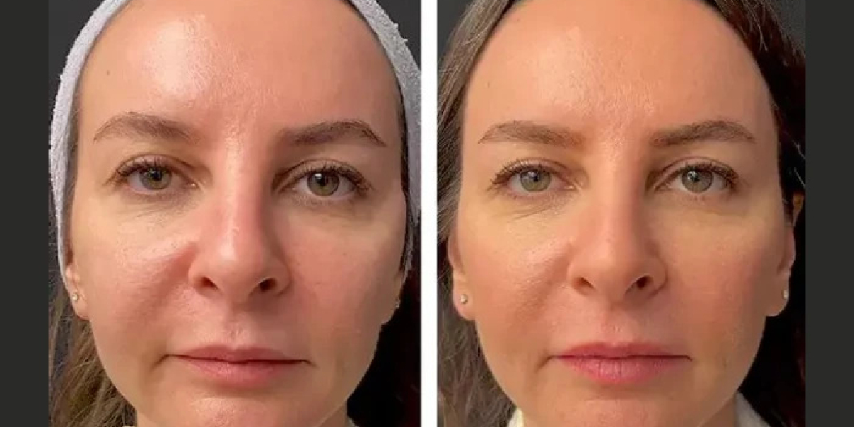 Best Aesthetic Clinics in Dubai for Skin Rejuvenation with Mesotherapy