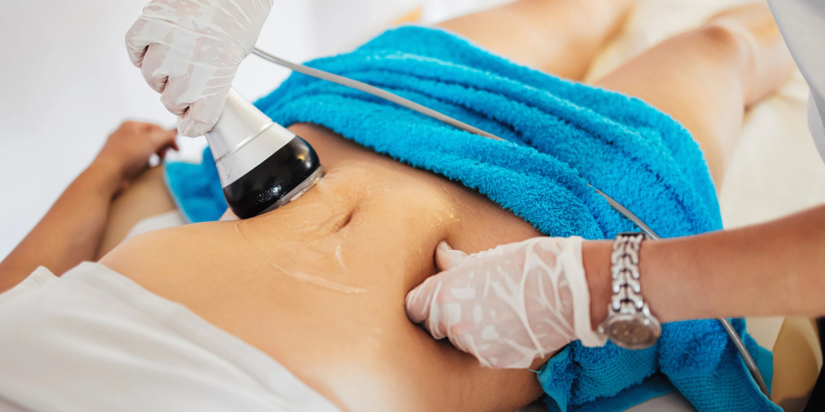 CoolSculpting Refines Profile Precisely, Improving Shape