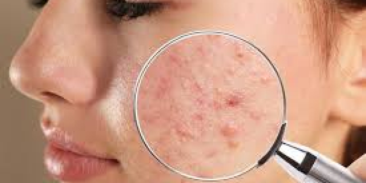 Face Acne: Causes, Treatments, and Tips for Clearer Skin