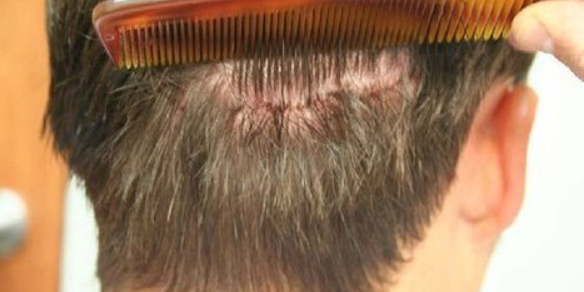 Beyond the Blade: The 2026 Tech Powering Every Hair Transplant in Riyadh
