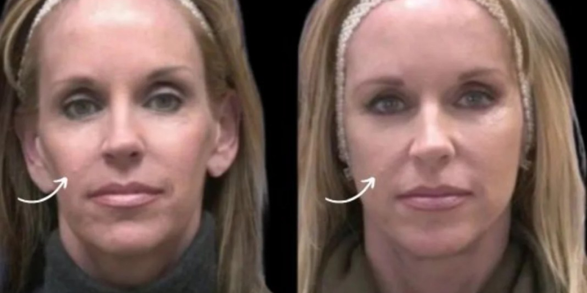 Sculptra Safety Standards Followed by Best Doctors in Dubai