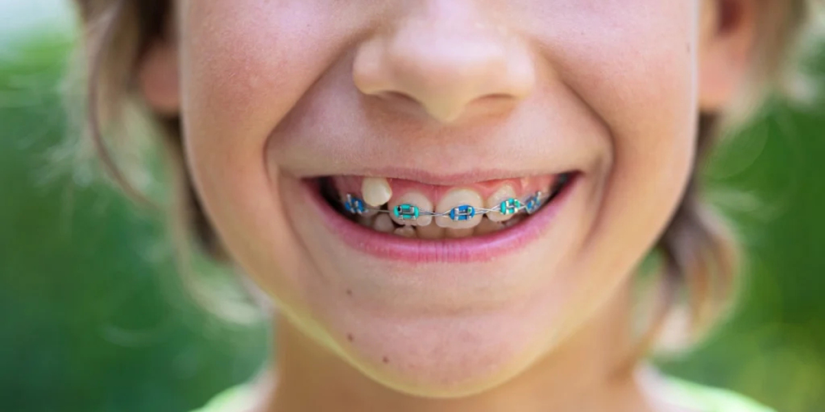 How to Prevent Dental Braces Damage
