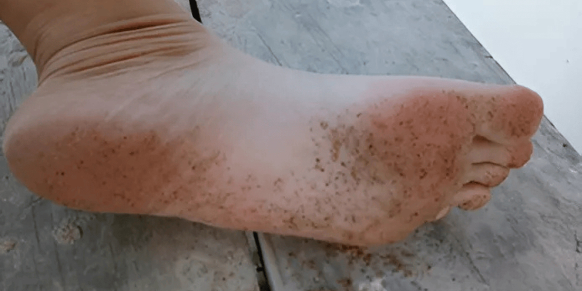 Black-Patches-on-Bottom-of-Feet: Should You Worry?