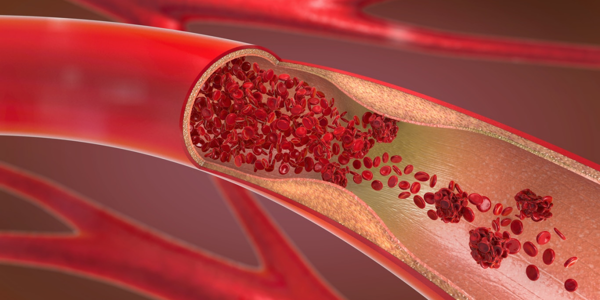 Peripheral Vascular Disease: Symptoms, Causes, and Treatment Options You Should Know