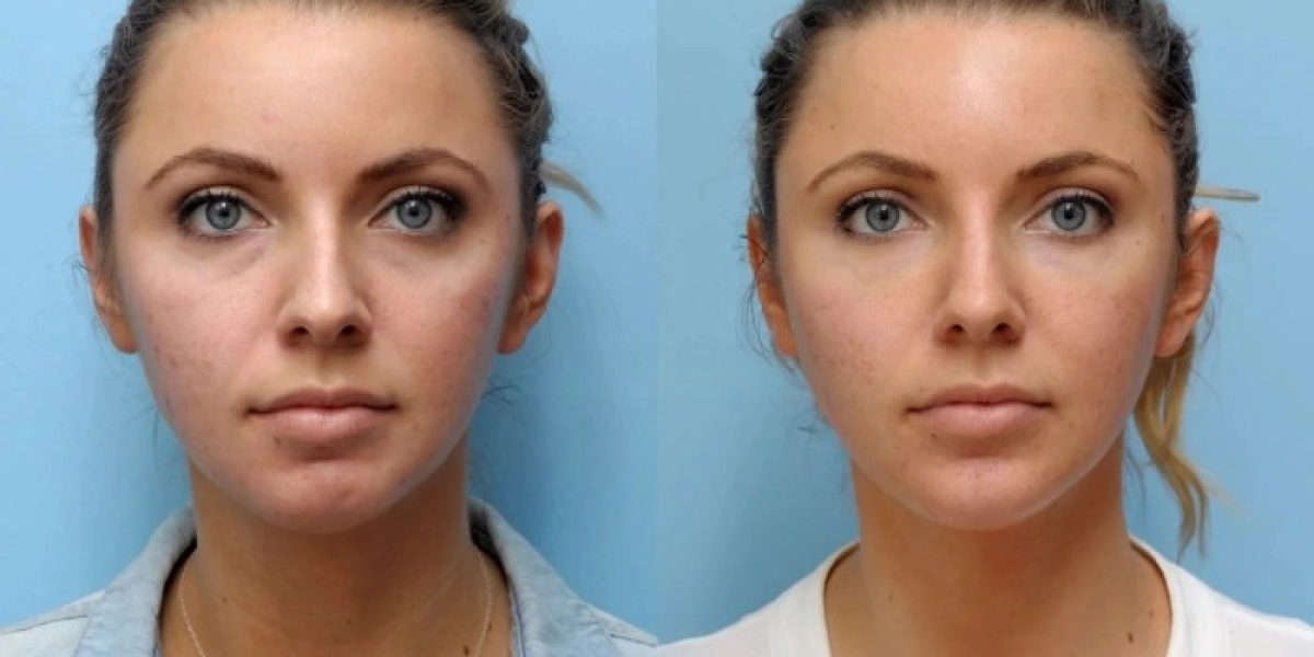 Thread Lift by Best Doctors in Dubai for Facial Skin Firming