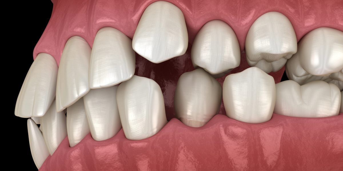 Crooked Teeth Treatment with Modern Orthodontics