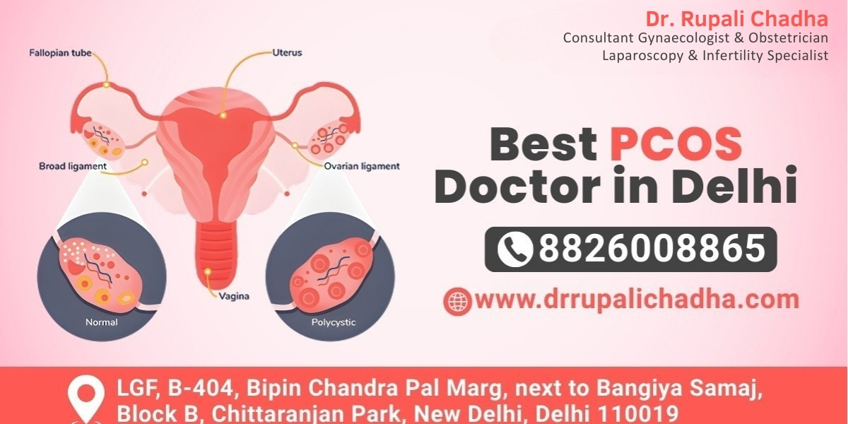 Looking for the Best PCOS Doctor in Delhi? Here’s How Expert Care Helps