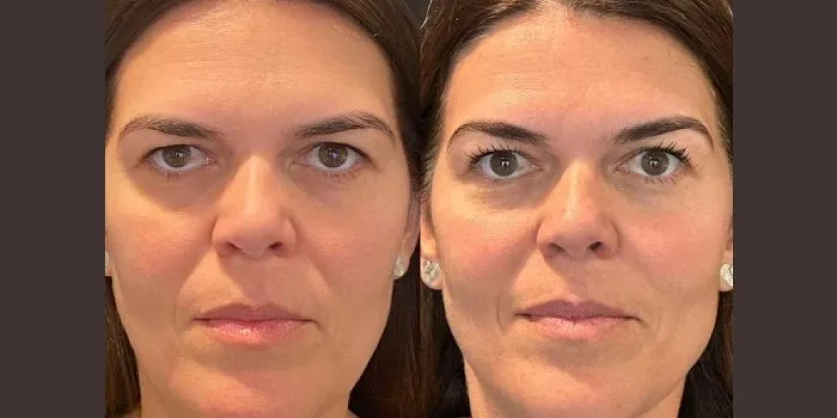 Best Aesthetic Clinics in dubai Offering Safe & Effective Thread Lift