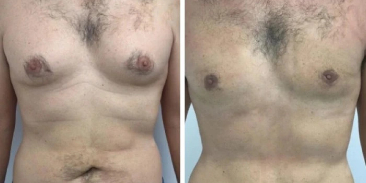 Emotional Benefits of Treatment with the Best Gynecomastia Surgeon in dubai