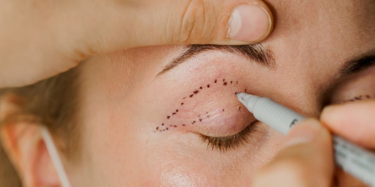 Common Myths About Eyelid Surgery—Debunked