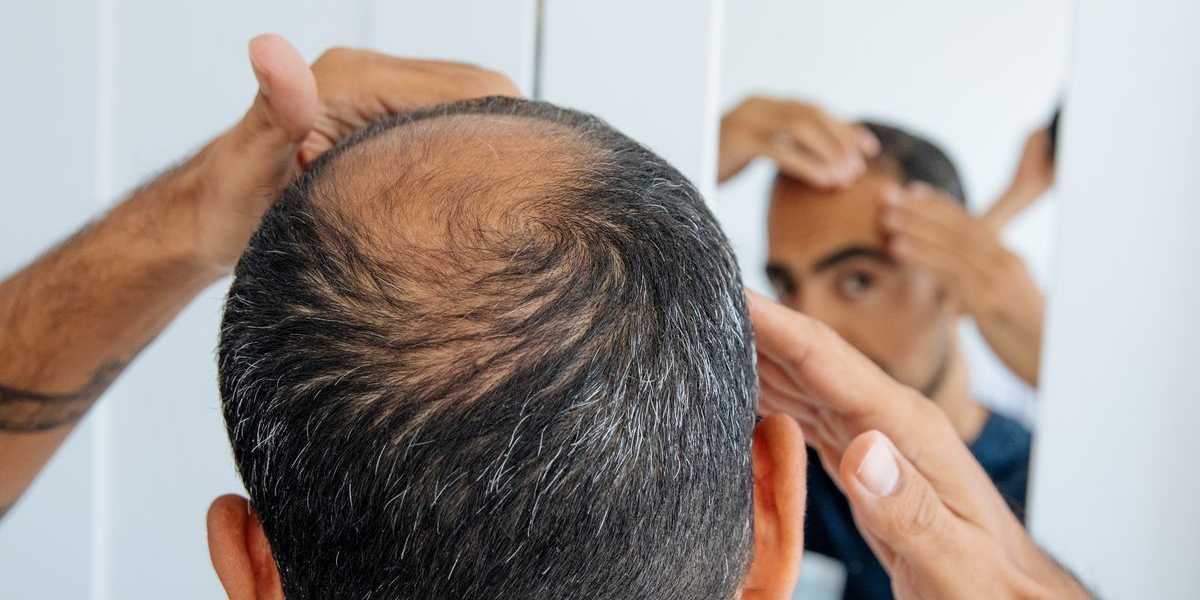 Hair Restoration Procedures Designed for Natural-Looking Results