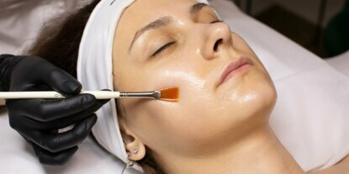 Chemical Peels That Help You Feel Confident in Your Natural Skin