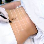 Liposuction procedure in Riyadh